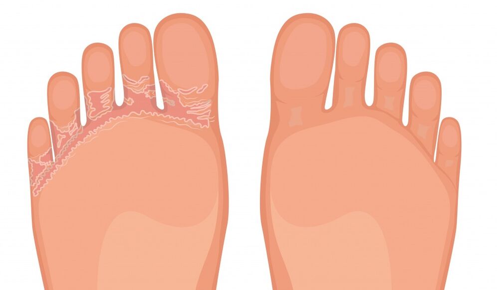 Brand Fungent Dandent Effective on all types of foot fungus
