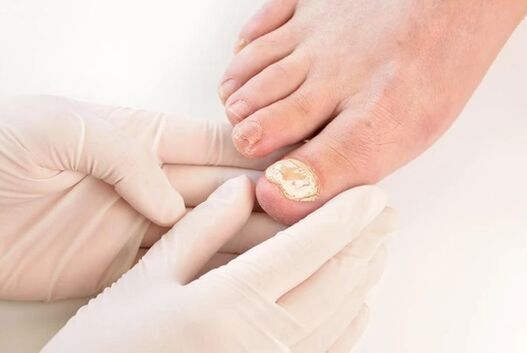 Doctors recommend a brand for mycoses treatment