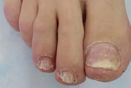 Nails are highly affected by fungus