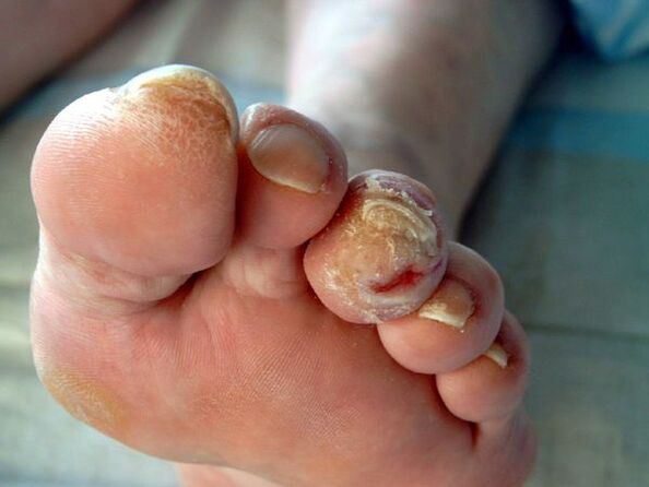 Feet of diabetes and onychomycosis