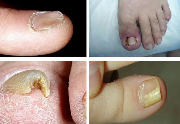 Symptoms of onychomycosis in the legs