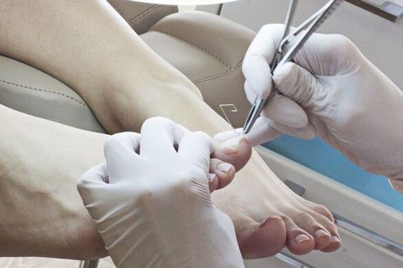 The removal of mechanical nails affected by fungus
